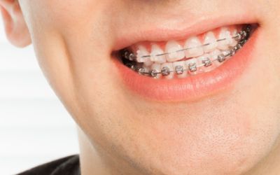 Centra Dental - Ceramic Braces vs. Traditional South Houston Braces: Which Is the Right Choice for You?
