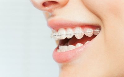 Centra Dental - Centra Dental in South Houston Offers Ceramic Houston Braces For Adults