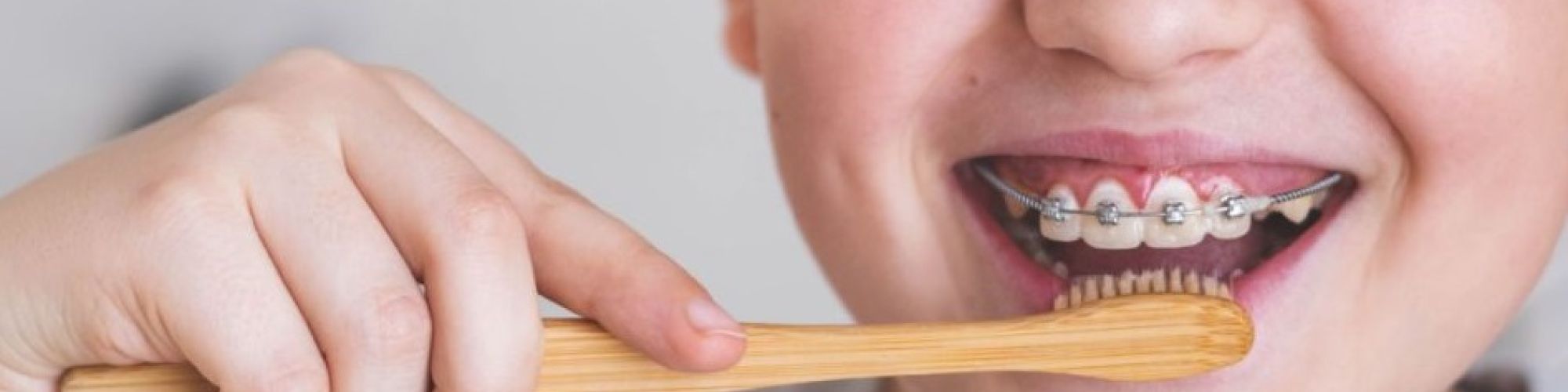 Centra Dental - How to Care for Your South Houston Dental Braces