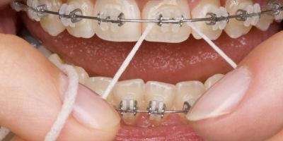 Centra Dental - Maintaining Oral Hygiene with Metal Houston Braces