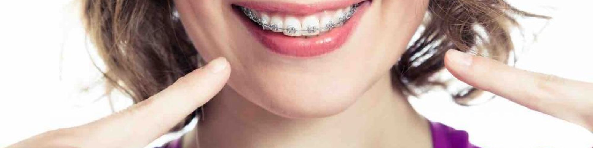Centra Dental - Can Adults Wear Dental Braces Too?
