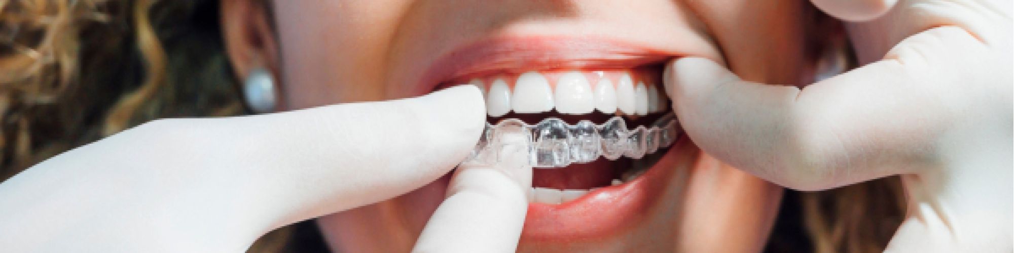 Centra Dental - Is Houston Invisalign Right For You? Get Clear Aligners For $2495
