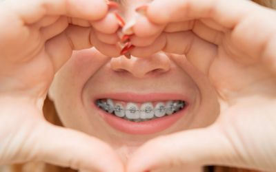 Centra Dental - How to Choose the Right Type of South Houston Braces for You