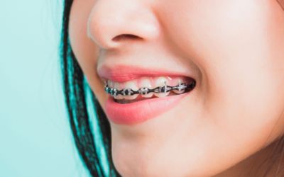 Centra Dental - Ceramic Houston Braces Versus Metal Braces, A Quick Introduction