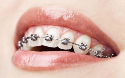 Centra Dental - Correct Overbites With Metal Dental Braces At Our South Houston Dentist