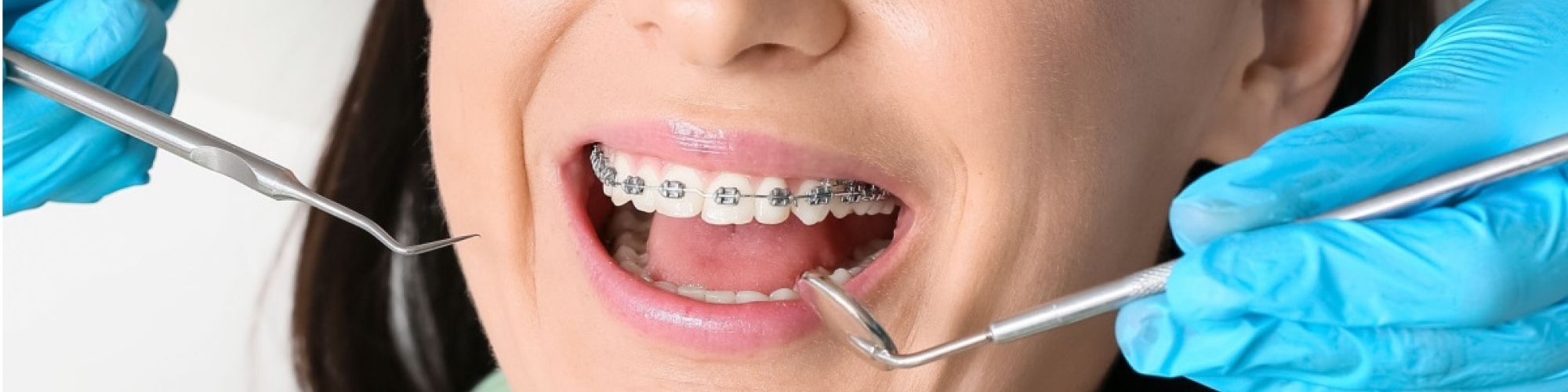 Centra Dental - Why Get Houston Braces?