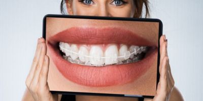 Centra Dental - South Houston Ceramic Braces vs Invisalign