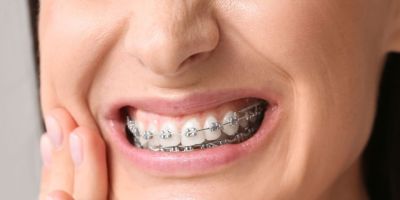 Centra Dental - What to Do About South Houston Braces Pain