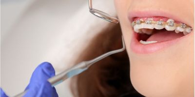 Centra Dental - Dental Cleaning With Braces by a South Houston Dentist
