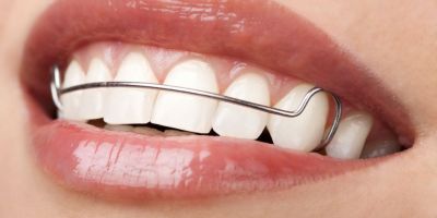 Centra Dental - Wear Your Retainers After Houston Braces Treatment