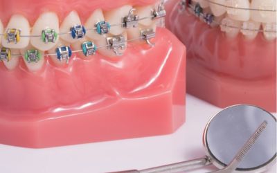 Centra Dental - Which Houston Braces Are Right for You?