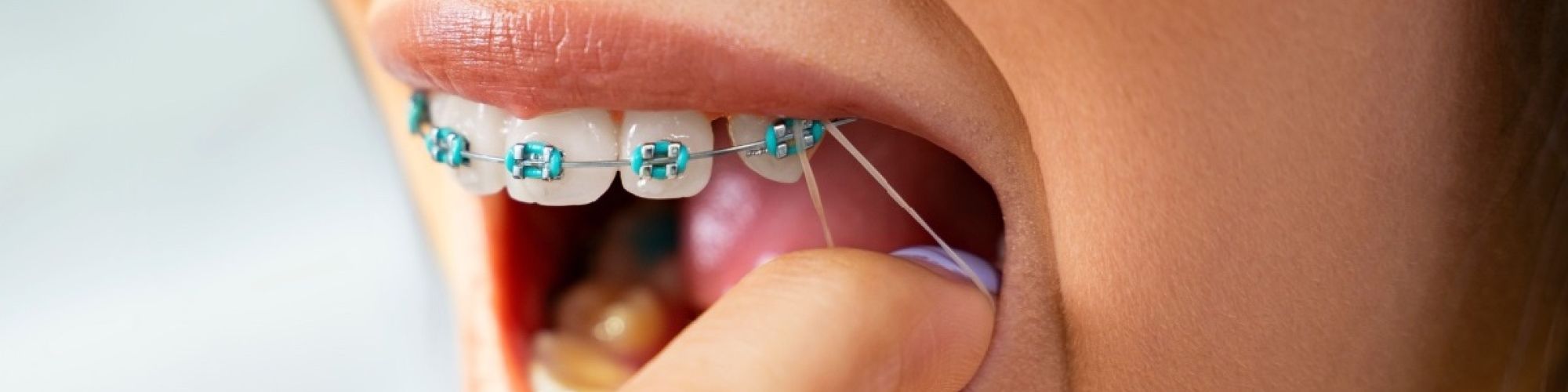 Centra Dental - Why Wearing Your Elastics With Houston Braces Is a Must