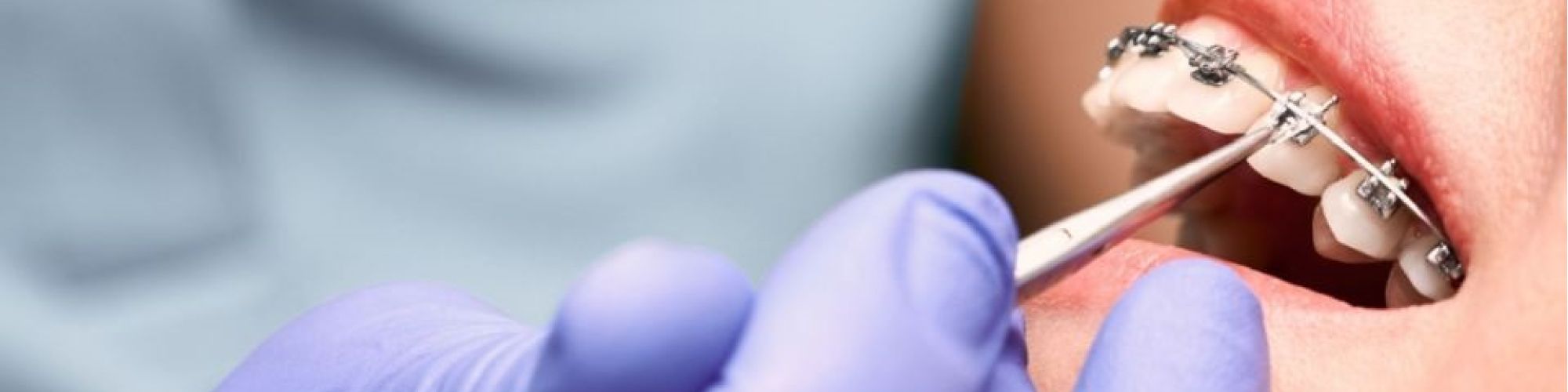 Centra Dental - The Process of Getting South Houston Metal Braces