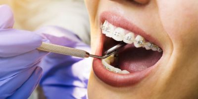 Centra Dental - What to Expect When First Getting Dental Braces at Centra Dental in South Houston