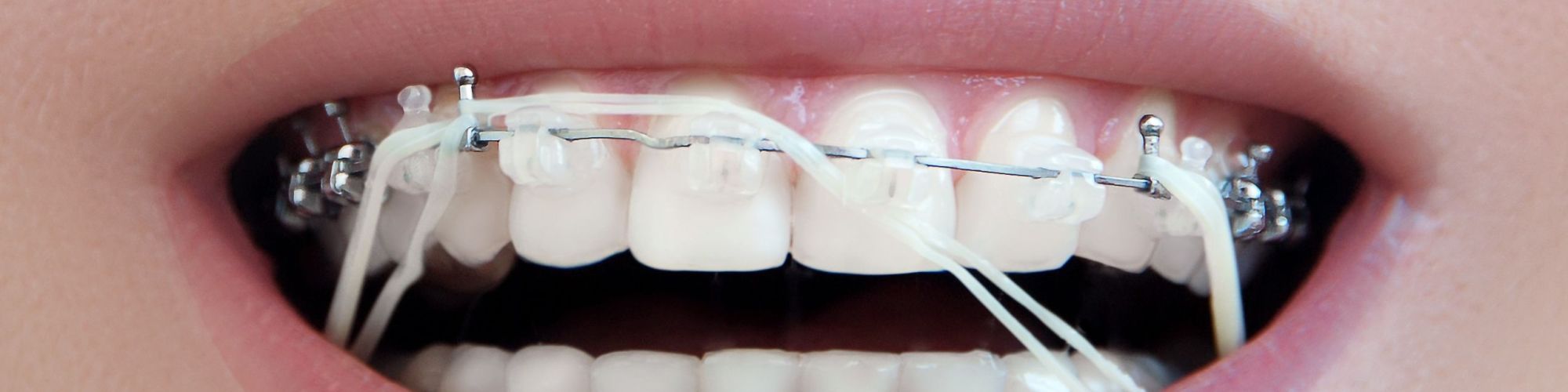 Centra Dental - When Do South Houston Braces Patients Have to Wear Rubber Bands?