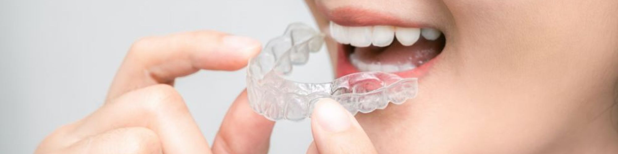 Centra Dental - How South Houston Invisalign Works