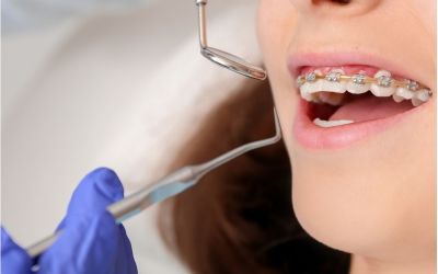 Centra Dental - Dental Cleaning With Braces by a South Houston Dentist