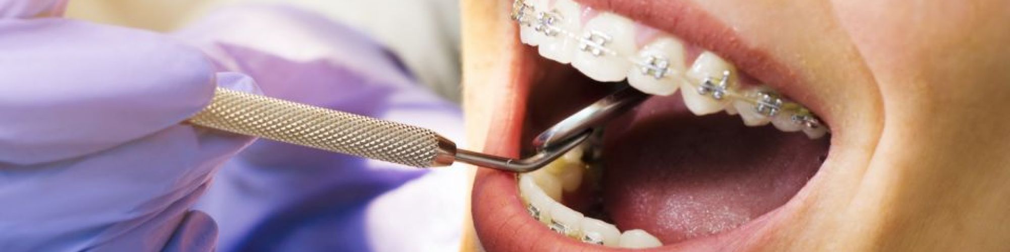 Centra Dental - What to Expect When First Getting Dental Braces at Centra Dental in South Houston