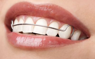 Centra Dental - Wear Your Retainers After Houston Braces Treatment