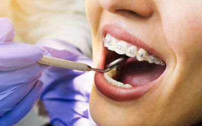 Centra Dental - What to Expect When First Getting Dental Braces at Centra Dental in South Houston