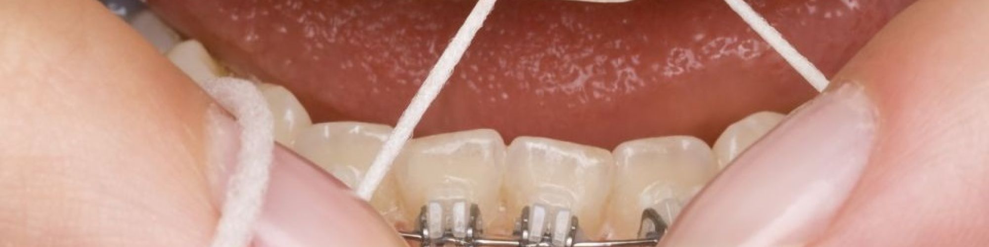 Centra Dental - Dental Cleanings with Houston Braces