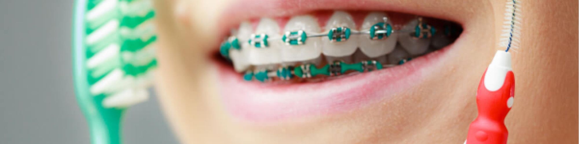 Centra Dental - Good Hygiene While Wearing Houston Braces