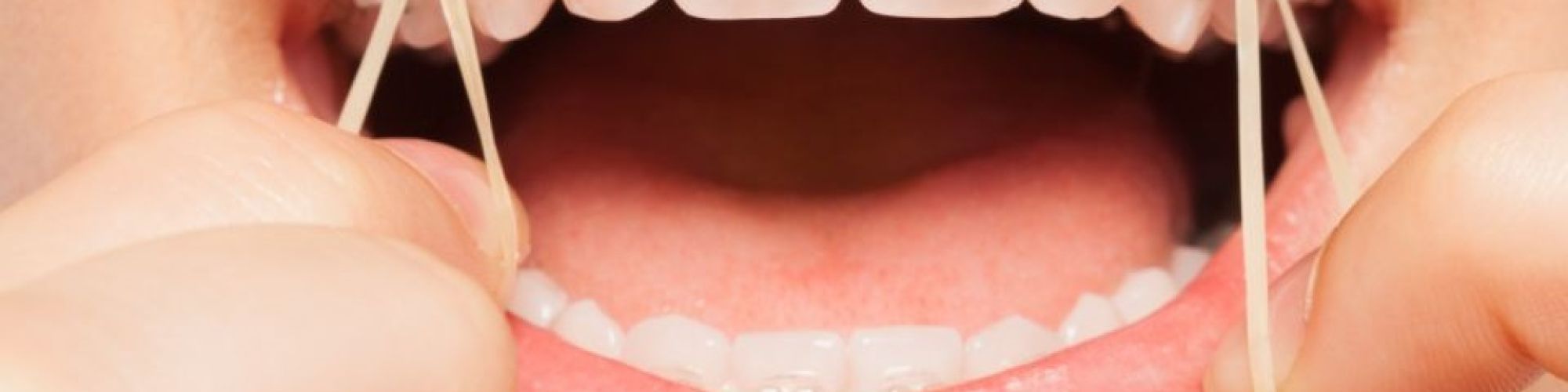 Centra Dental - Why You Might Need Rubber Bands with Houston Braces