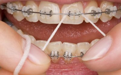 Centra Dental - Maintaining Oral Hygiene with Metal Houston Braces