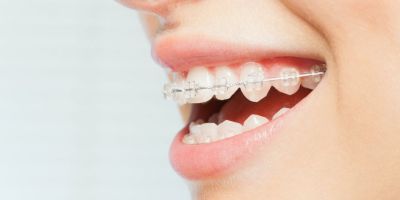Centra Dental - Centra Dental in South Houston Offers Ceramic Houston Braces For Adults