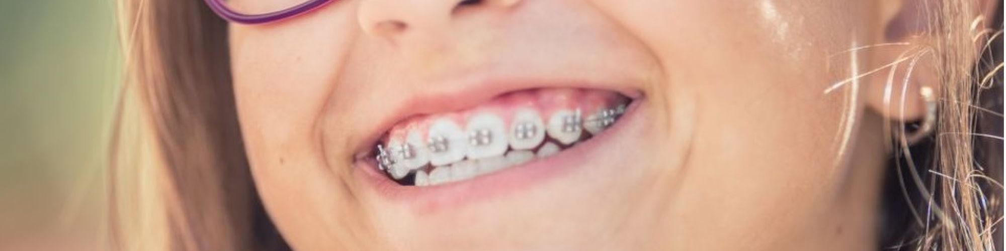 Centra Dental - Benefits of Getting Houston Braces at a Young Age