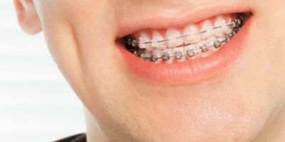 Centra Dental - Ceramic Braces vs. Traditional South Houston Braces: Which Is the Right Choice for You?