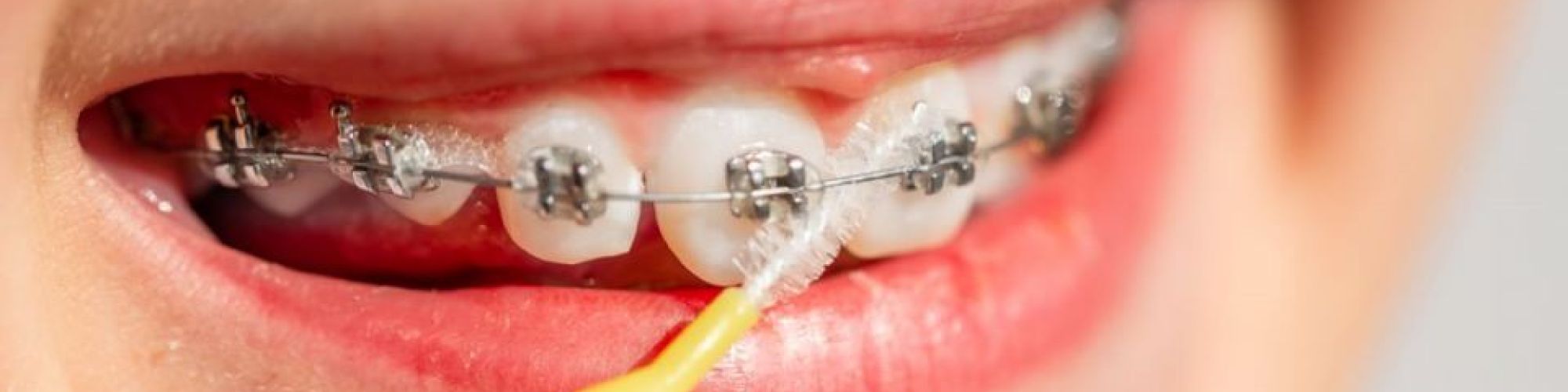 Centra Dental - How to Keep Your Teeth Clean While Wearing Houston Braces