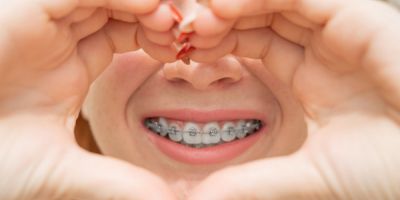Centra Dental - How to Choose the Right Type of South Houston Braces for You