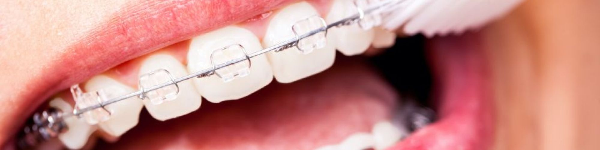 Centra Dental - How to Keep Your Teeth Clean and Healthy While Wearing Houston Braces