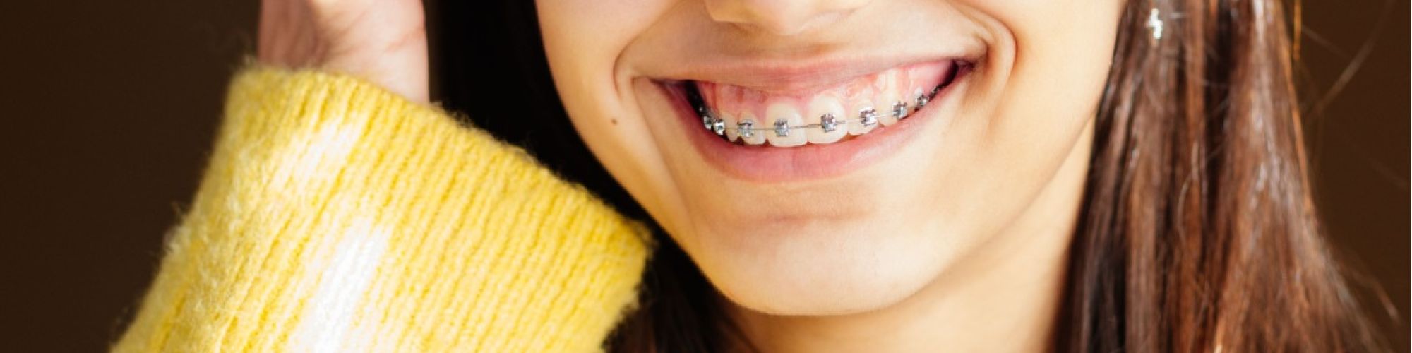 Centra Dental - Should You Get Ceramic Houston Braces or Metal Dental Braces?