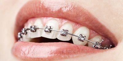 Centra Dental - Correct Overbites With Metal Dental Braces At Our South Houston Dentist