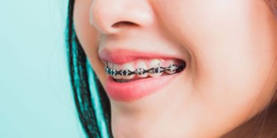 Centra Dental - Ceramic Houston Braces Versus Metal Braces, A Quick Introduction