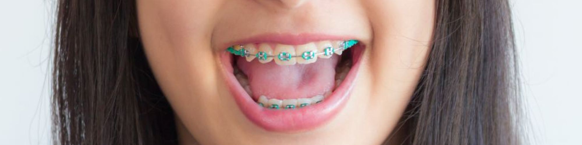 Centra Dental - Houston Metal Braces For Children
