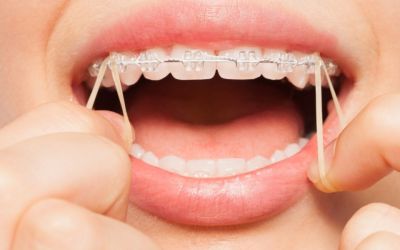 Centra Dental - Why You Might Need Rubber Bands with Houston Braces