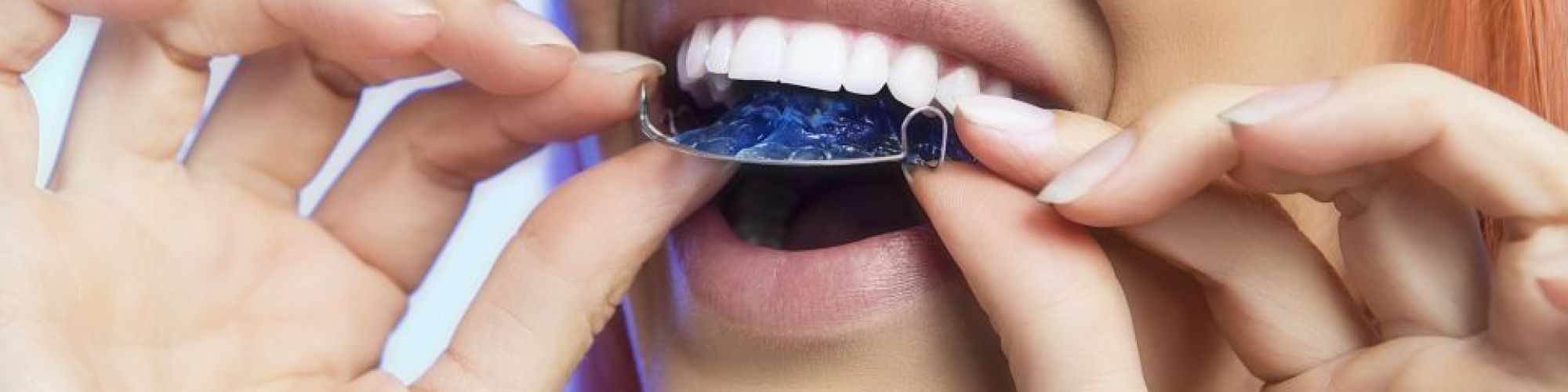 Centra Dental - Ceramic Houston Braces: The Perfect Compromise