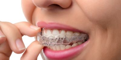 Centra Dental - Is South Houston Invisalign Right For You
