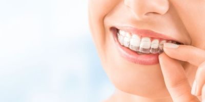 Centra Dental - Pros And Cons Of South Houston Invisalign