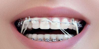 Centra Dental - When Do South Houston Braces Patients Have to Wear Rubber Bands?