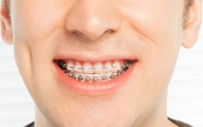 Centra Dental - The Pros and Cons of Ceramic vs Metal South Houston Braces