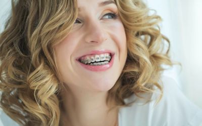 Centra Dental - When Are Metal Houston Braces Recommended