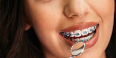 Centra Dental - How Long Do You Need to Have Houston Braces?