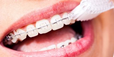 Centra Dental - How to Keep Your Teeth Clean and Healthy While Wearing Houston Braces