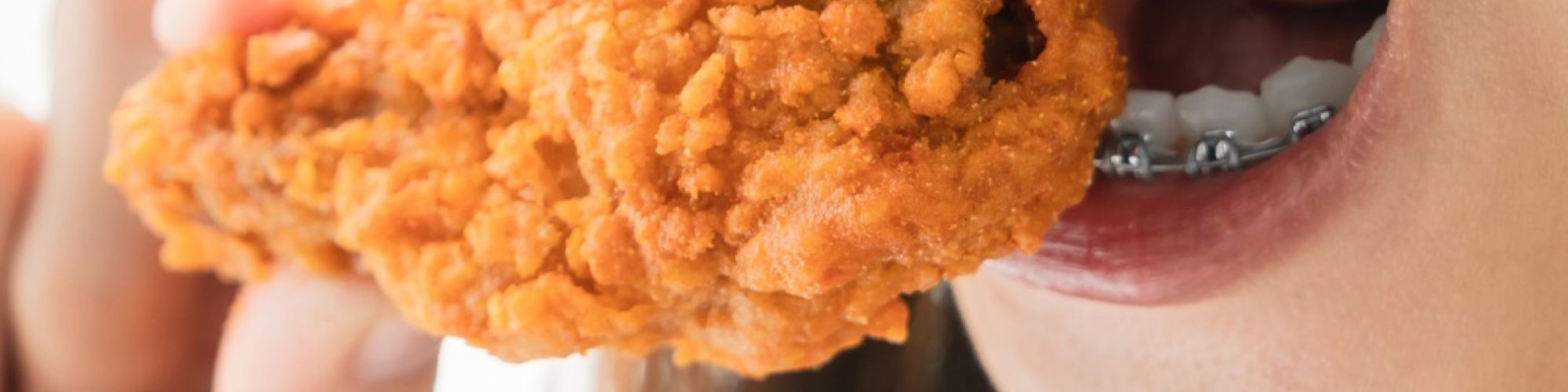 Centra Dental - Foods to Avoid With Houston Braces