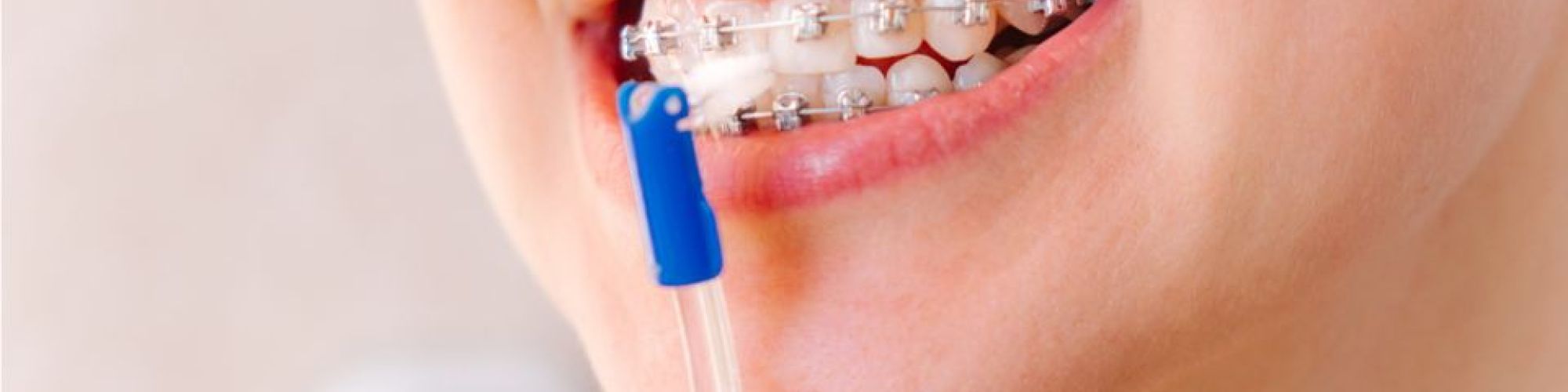 Centra Dental - Maintaining Your Oral Hygiene While Undergoing Houston Braces Treatment