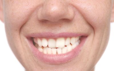 Centra Dental - Why You May Need Braces